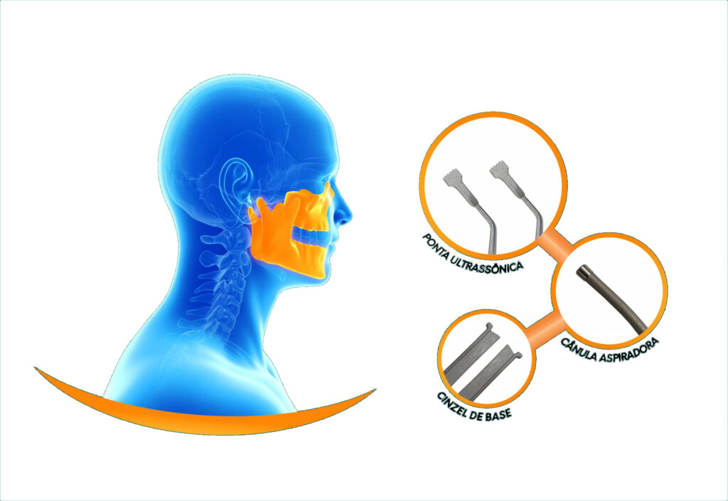 Imagem de perfil de um crânio humano na cor azul com destaque da mandíbula e do maxilar, mostrando também os instrumentos cirúrgicos apropriados.