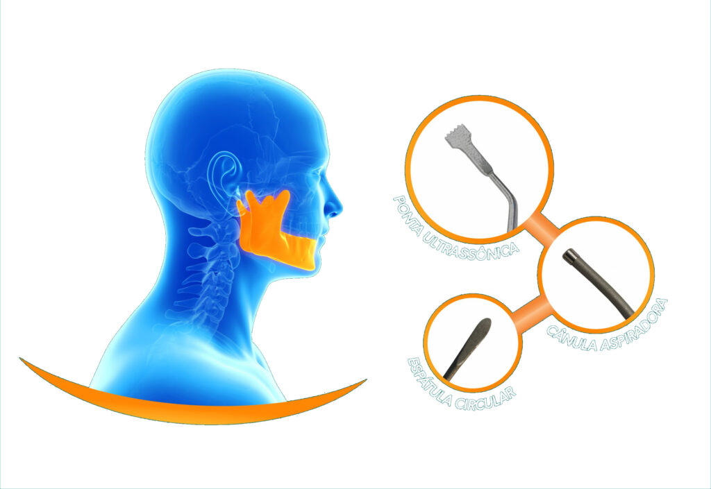 Imagem de perfil de um crânio humano na cor azul com destaque da mandíbula, mostrando também os instrumentos cirúrgicos apropriados.