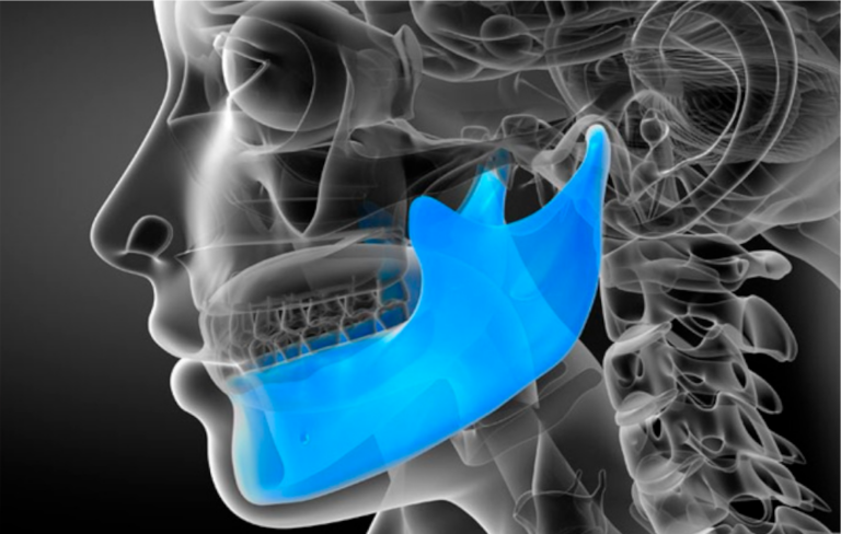 Raio-x de um crânio humano com destaque no maxilar